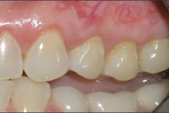 Alloderm_Graft_-_After