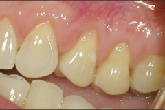 Alloderm_Graft_-_Before