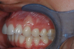 Left Side After