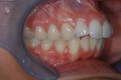 Right SIde After