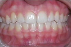 Crown_Lengthening_-_After