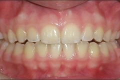 Crown_Lengthening_-_Before