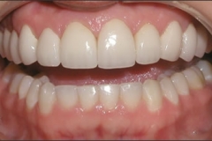 Smile_Makeover_-_After