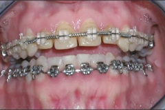 Smile_Makeover_-_Before