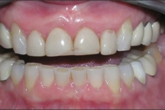 Sub-Epithelial_Connective_Tissue_Graft2_-_After
