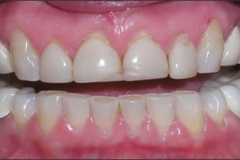 Sub-Epithelial_Connective_Tissue_Graft2_-_before