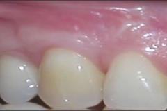 Sub-Epithelial_Connective_Tissue_Graft_-_After